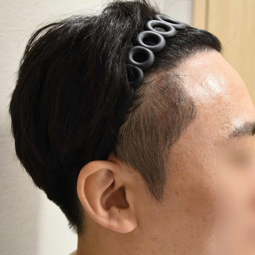 시술 이후 사진