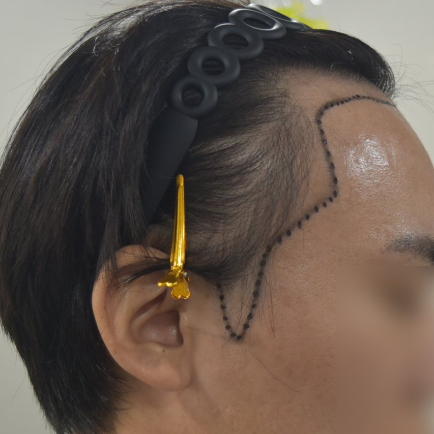 시술 이전 사진