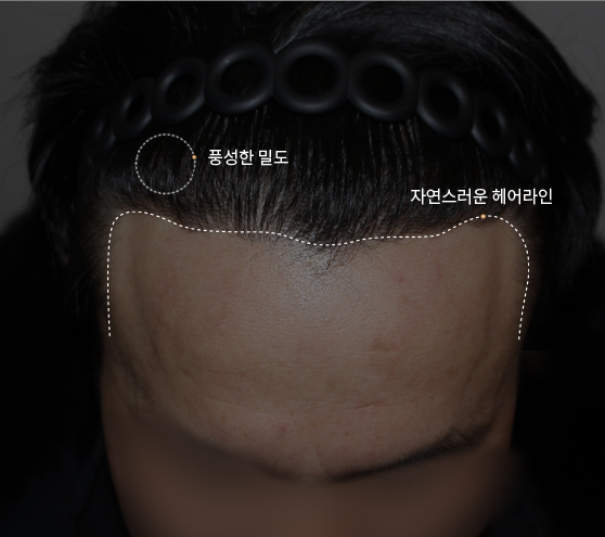 비절개 대량모 모발이식 후