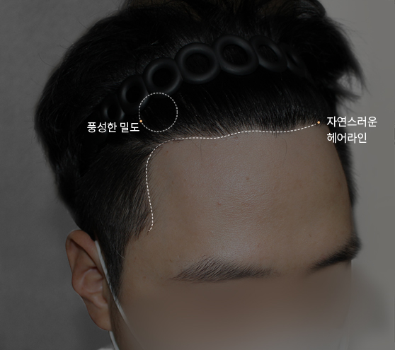 인비저블컷 모발이식 후