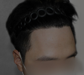 인비저블컷 모발이식 후 모바일