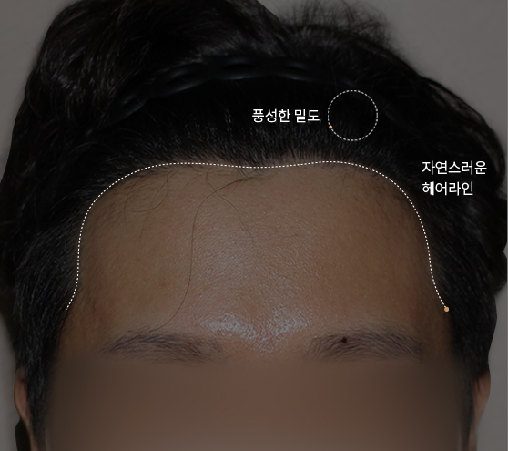 헤어라인 모발이식 후