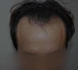 비절개 대량모 모발이식 전 모바일