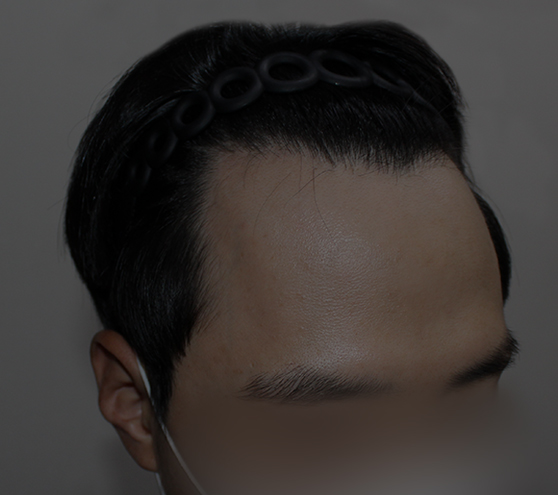 인비저블컷 모발이식 전